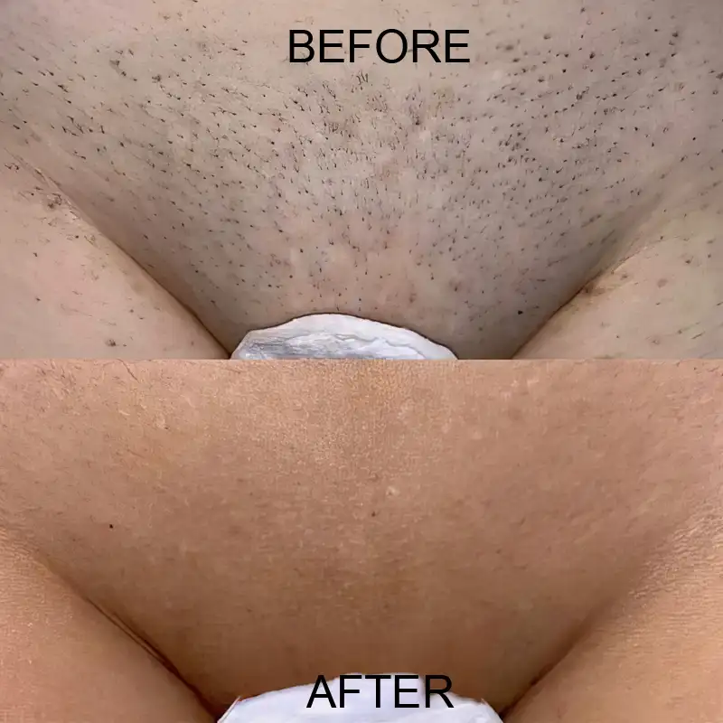 Before after pubis