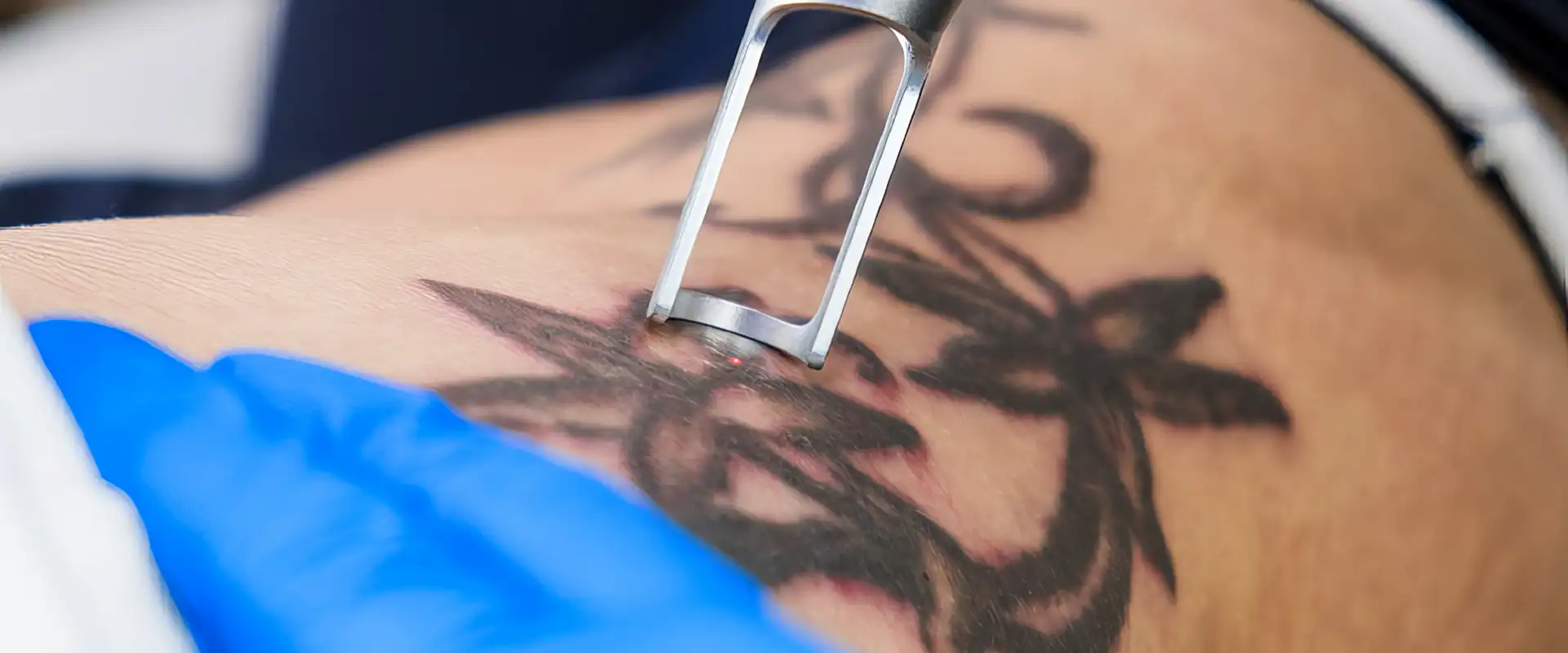 Laser tattoo removal