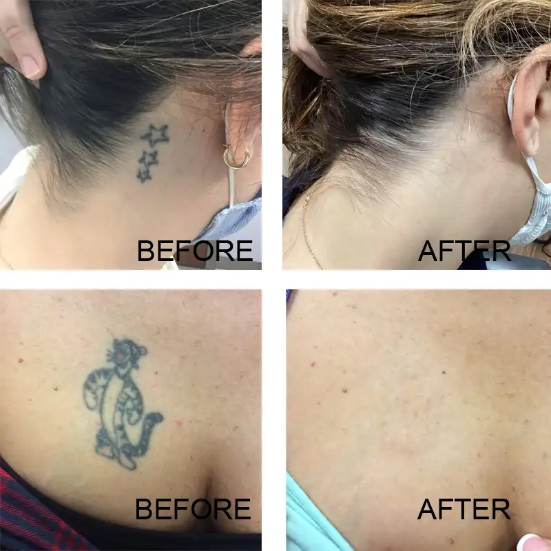 Tattoo removal before after